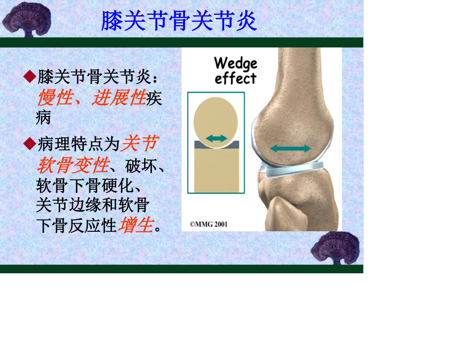 膝骨关节炎的防治..ppt_第2页