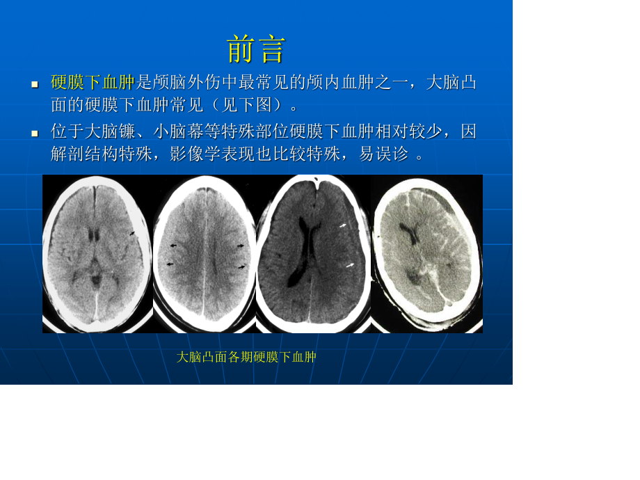 小脑幕硬膜下血肿.ppt_第2页