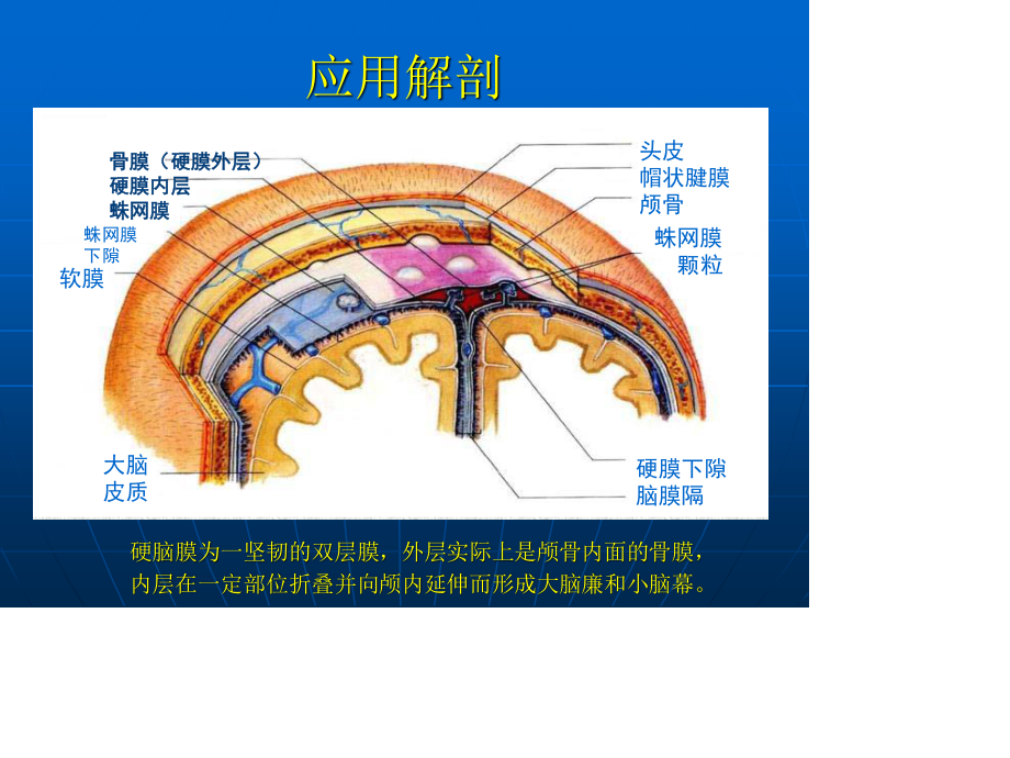 小脑幕硬膜下血肿.ppt_第3页