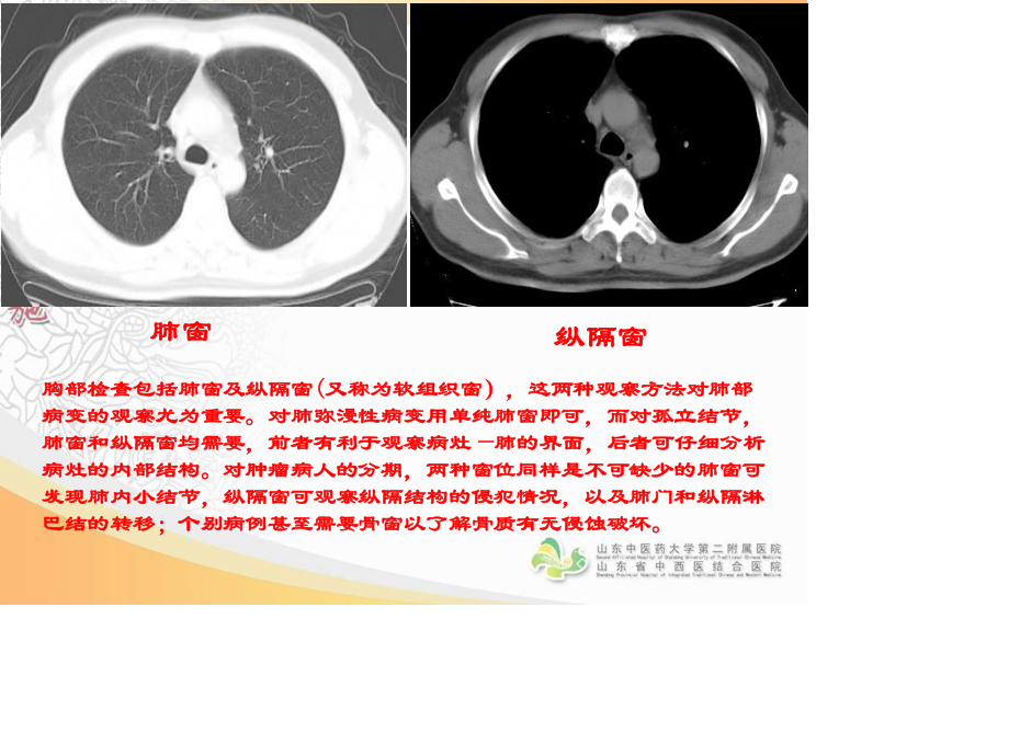 胸部影像学--CT篇.ppt_第2页