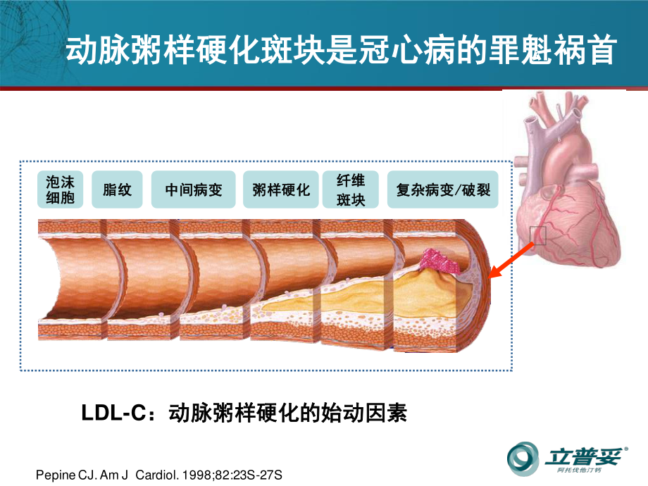 稳定性冠心病不稳定PIM.ppt_第3页