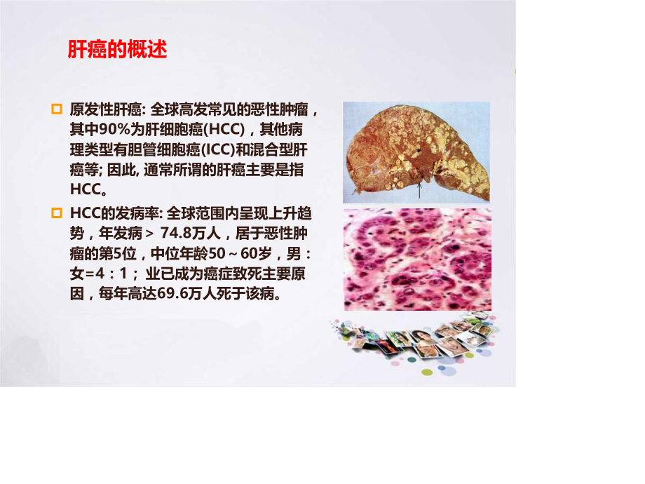 晚期肝癌.ppt_第2页