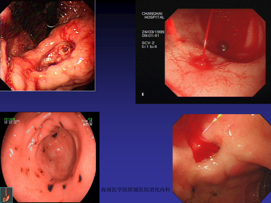 胃十二指肠出血.ppt_第2页