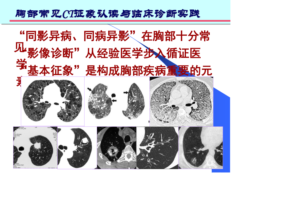 胸部常见CT征象.ppt_第2页