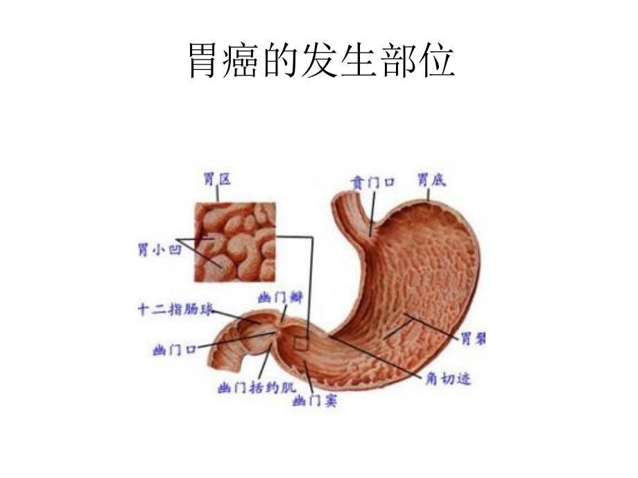 胃癌常见手术方式及术后并发症.ppt_第3页