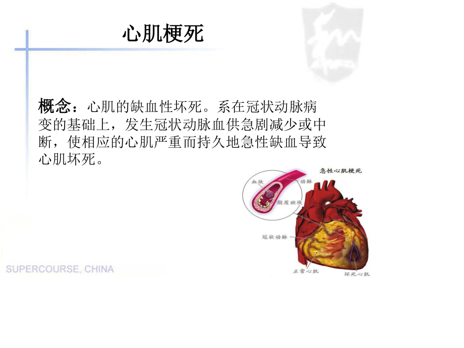 心肌梗死教学查房.ppt_第3页