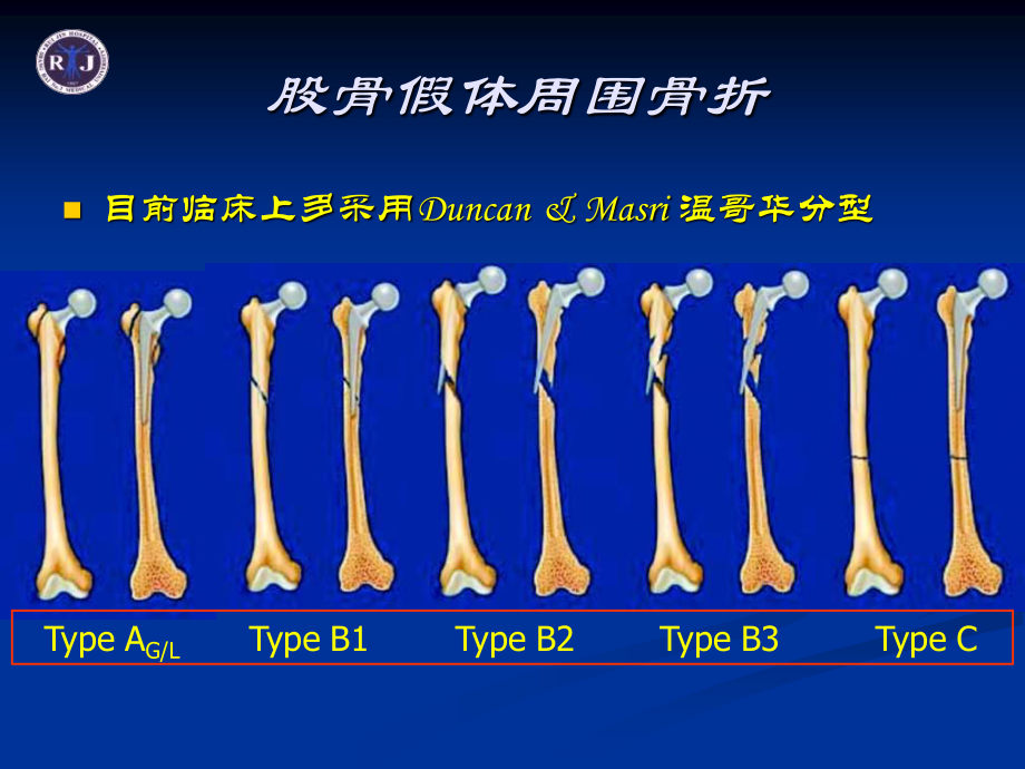 温哥华B3型股骨假体周围骨折.ppt_第3页