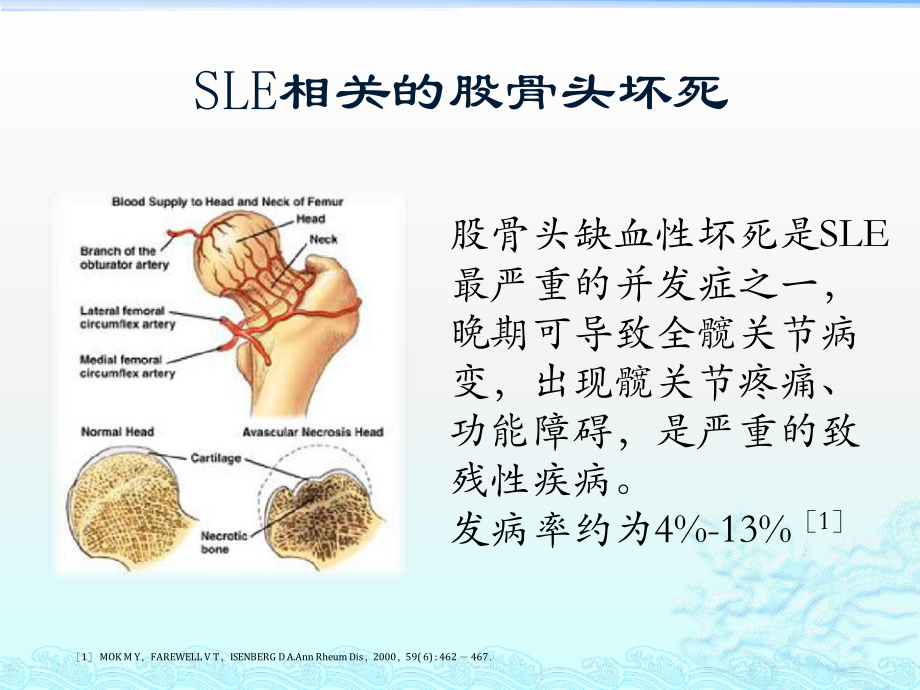 系统性红斑狼疮相关股骨头坏死.pptx_第3页