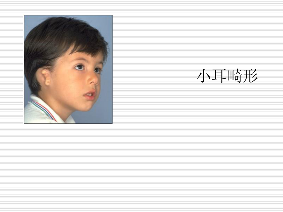 小耳畸形重建.ppt_第1页