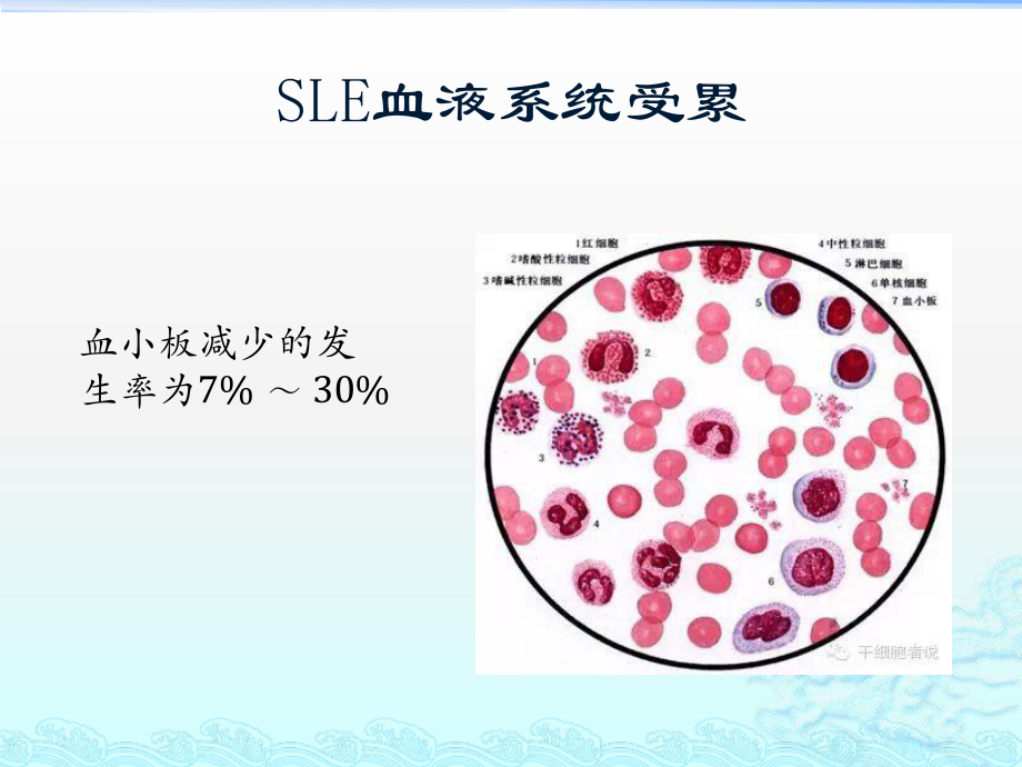 系统性红斑狼疮相关血小板减少.pptx_第3页