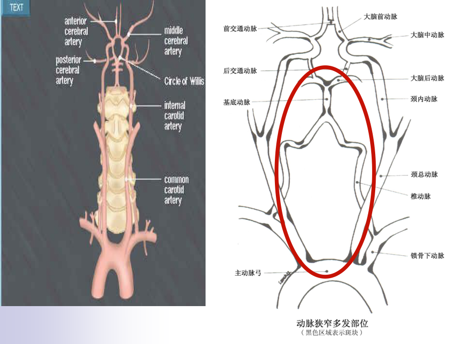 眩晕与后循环缺血.ppt_第3页