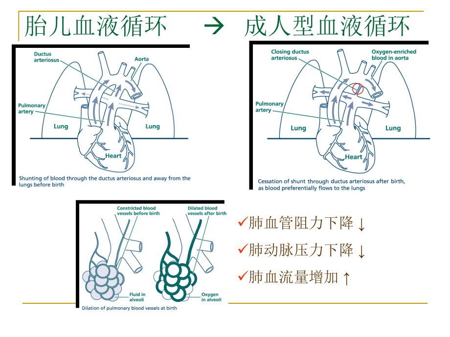 新生儿肺动脉高压.pptx_第3页