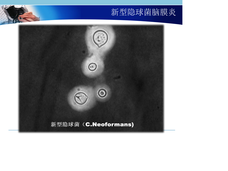 新型隐球菌脑膜炎.ppt_第3页