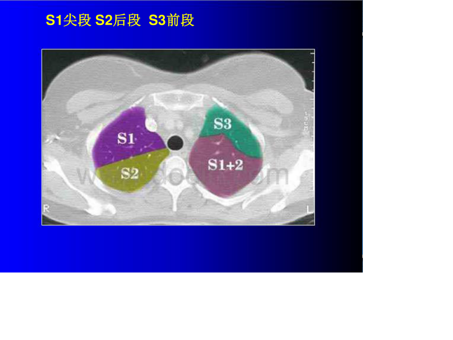 胸部CT读片指南.ppt_第3页