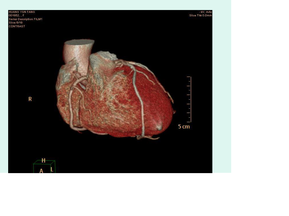 心脏冠状动脉CTA成.ppt_第3页