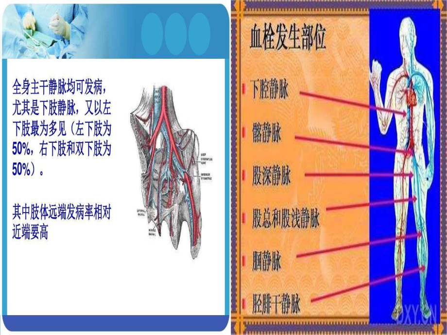 下肢深静脉血栓.ppt_第2页