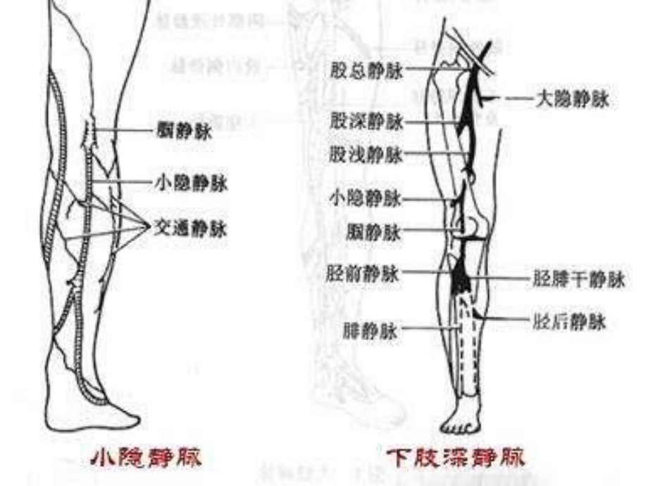 下肢深静脉血栓.ppt_第3页