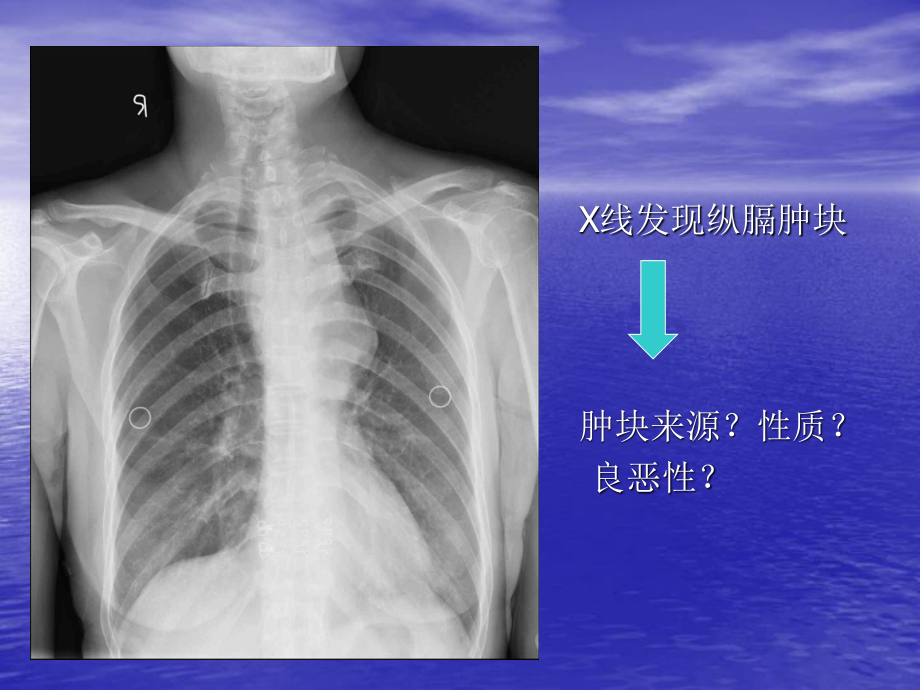 胸内甲状腺肿.ppt_第2页