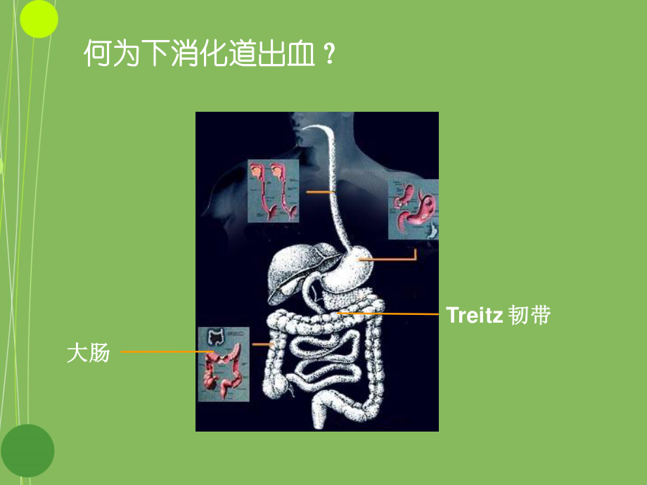 下消化道出血的诊治.ppt_第2页