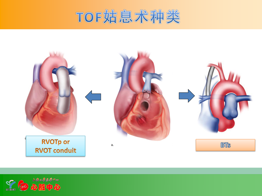 徐卓明-TOF姑息术后监护要点并发症及其处理(1).pptx_第2页