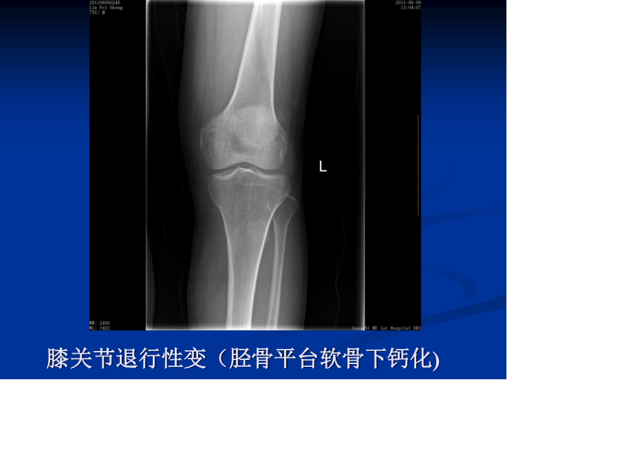 膝关节骨性关节炎资料.ppt_第2页