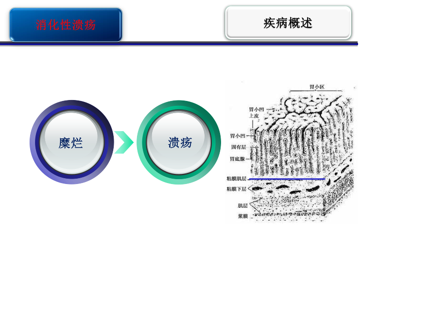 消化性溃疡护校.ppt_第3页