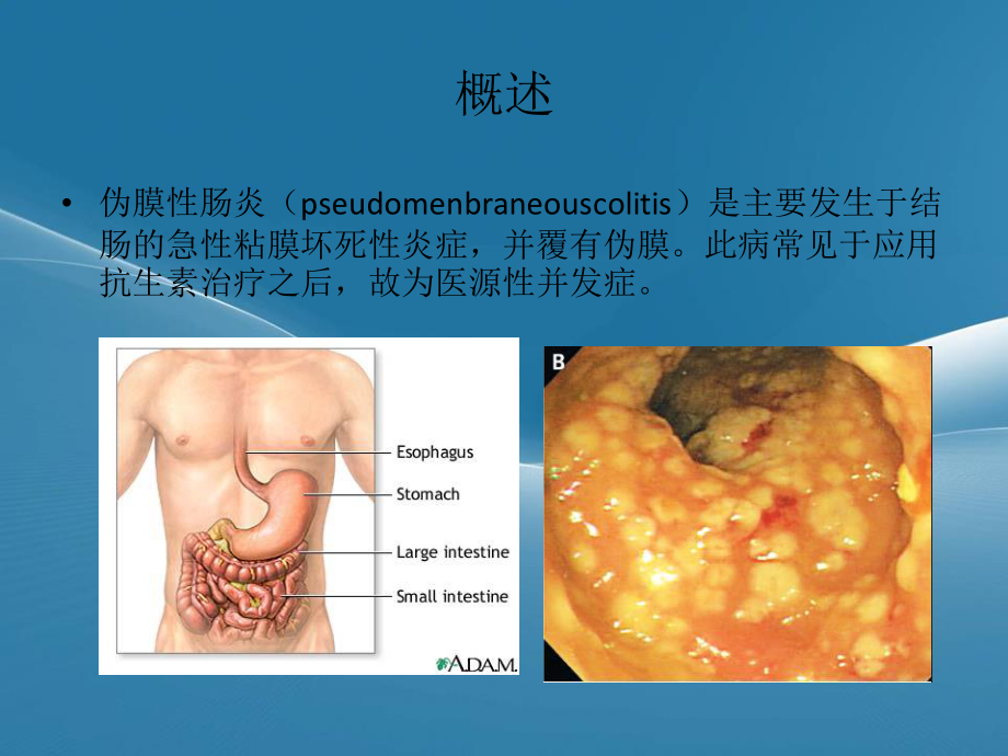 伪膜性肠炎..ppt_第2页