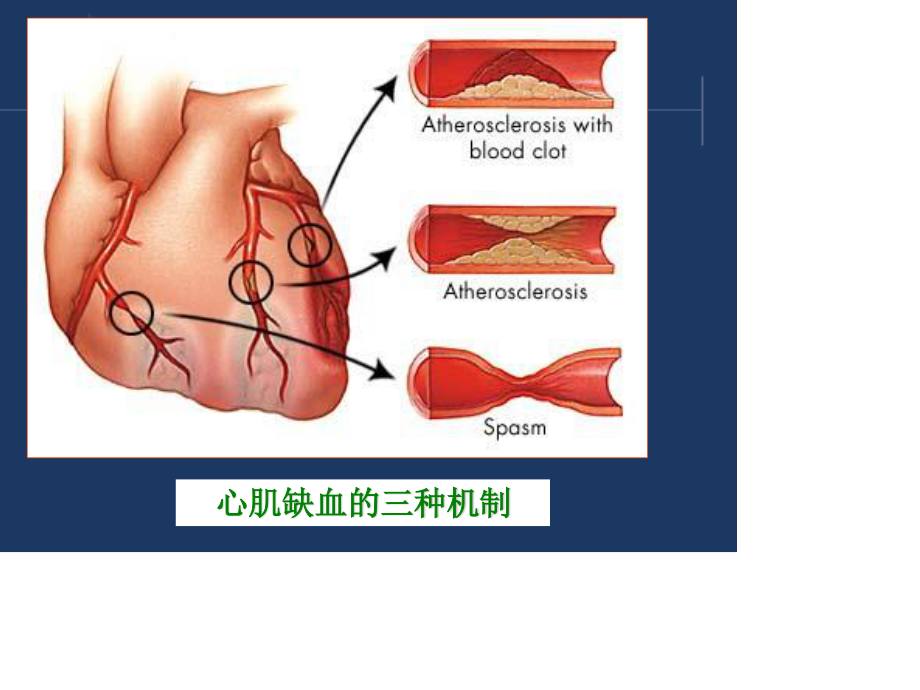 西药综合-第十章-冠状动脉粥样硬化性心脏病.ppt_第3页