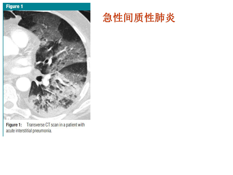 胸部影像学.ppt_第3页