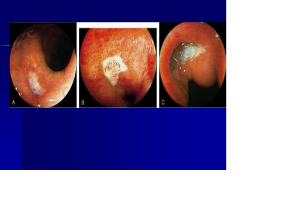 消化性溃疡20.ppt_第2页