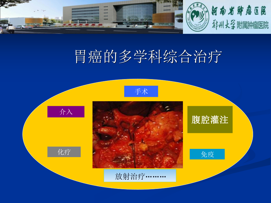 胃癌腹腔热灌注.ppt_第3页