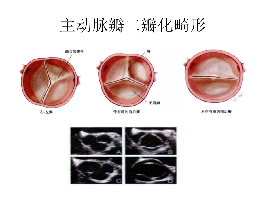 先天性心脏瓣膜病.ppt_第3页