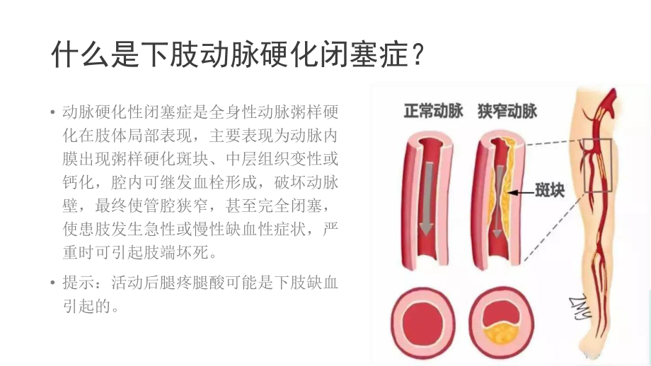 王丽艳(王俪艳)提示中老年腿疼腿酸别忽视-警惕下肢动脉硬化闭塞症.pptx_第3页