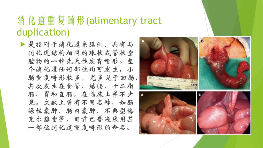 消化道重复畸形(97-2003).ppt_第2页