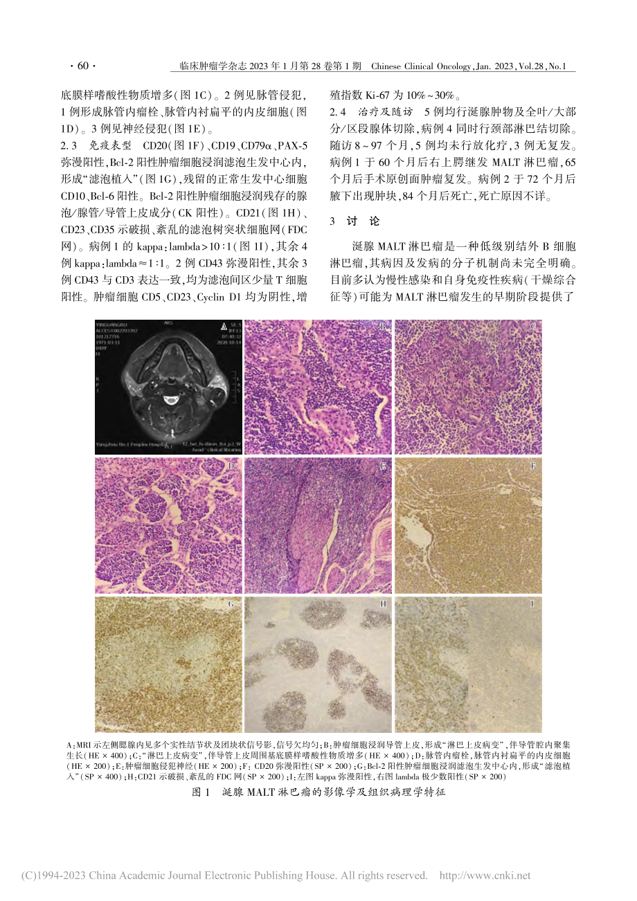 涎腺原发性MALT淋巴瘤5例临床病理分析_杨家佳.pdf_第3页