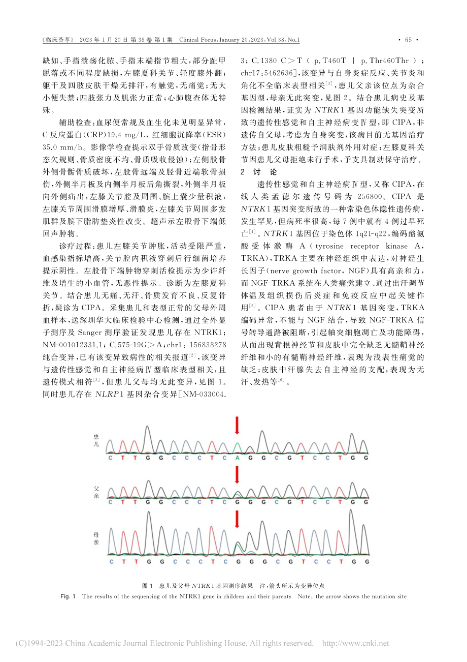 先天性无痛无汗症1例并文献复习_庞姝.pdf_第2页