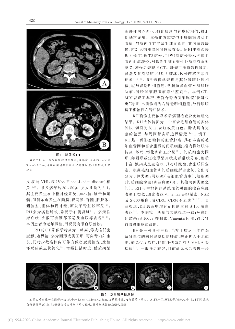 原发性肾血管母细胞瘤1例报道_殷思范.pdf_第2页