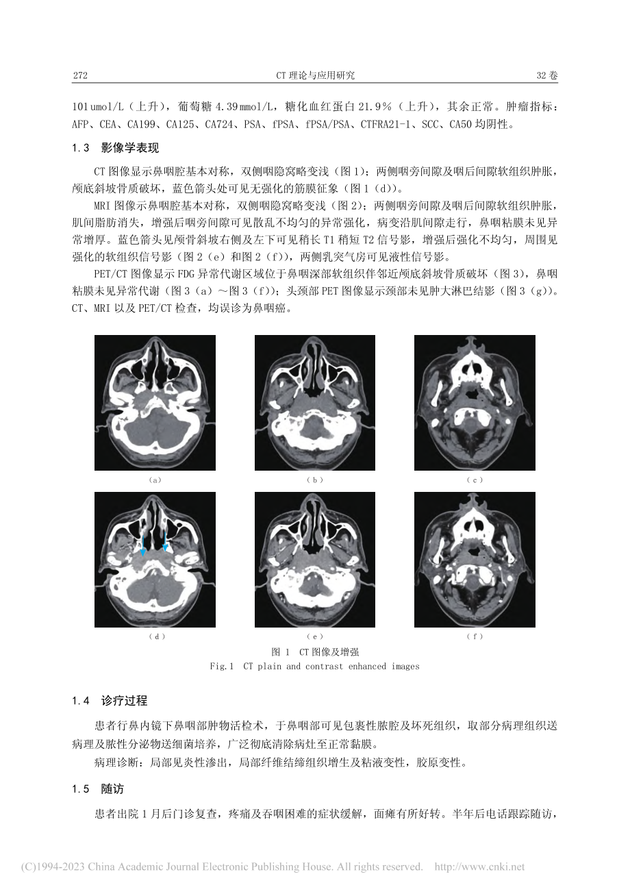 影像学诊断罕见发生于鼻咽部...部坏死性筋膜炎临床案例分析_邓侃.pdf_第2页