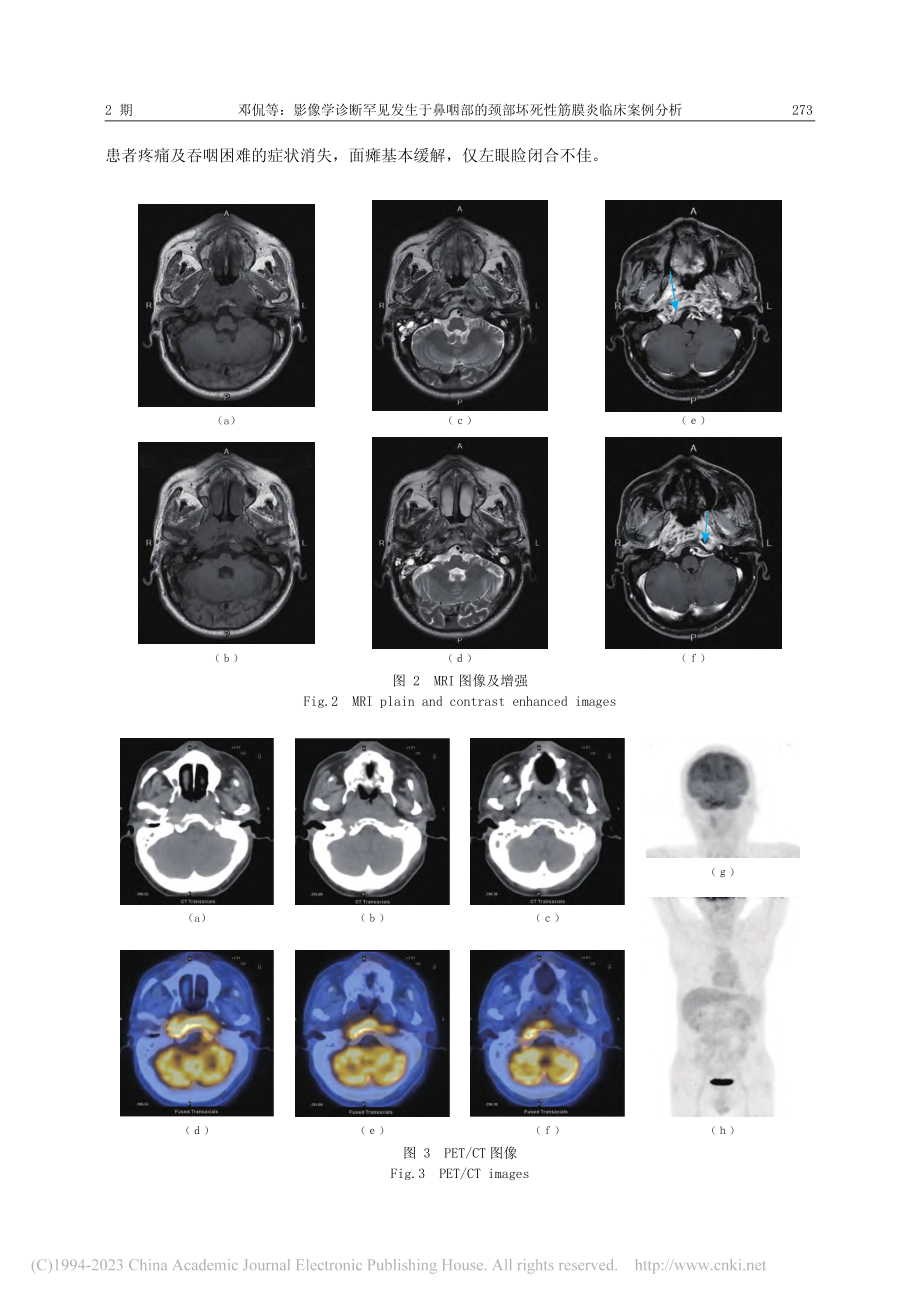 影像学诊断罕见发生于鼻咽部...部坏死性筋膜炎临床案例分析_邓侃.pdf_第3页