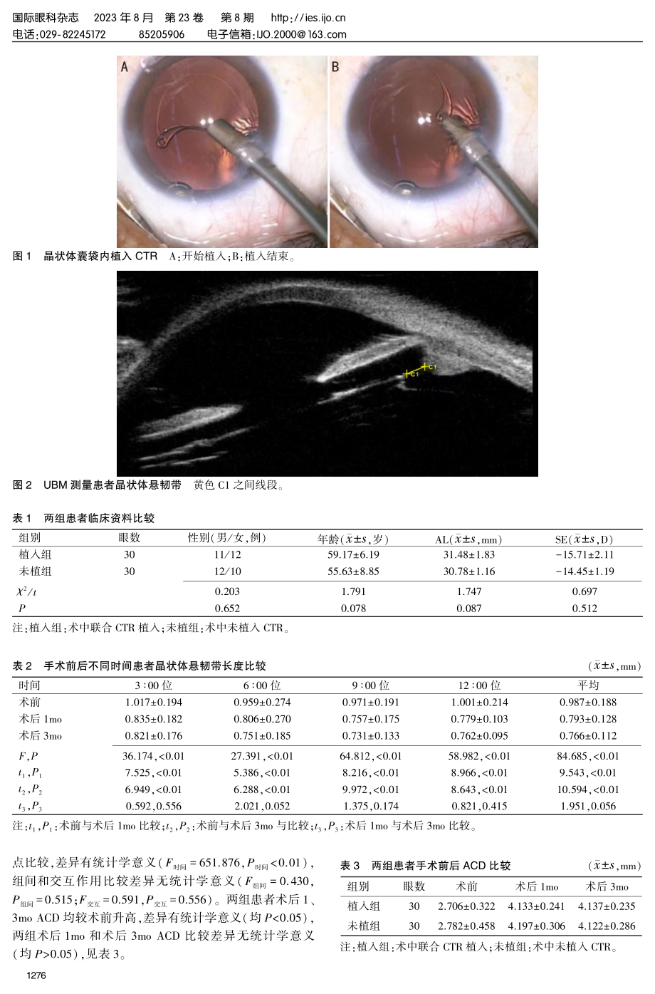 超高度近视合并白内障患者术后ACD和晶状体悬韧带的变化及相关影响因素.pdf_第3页