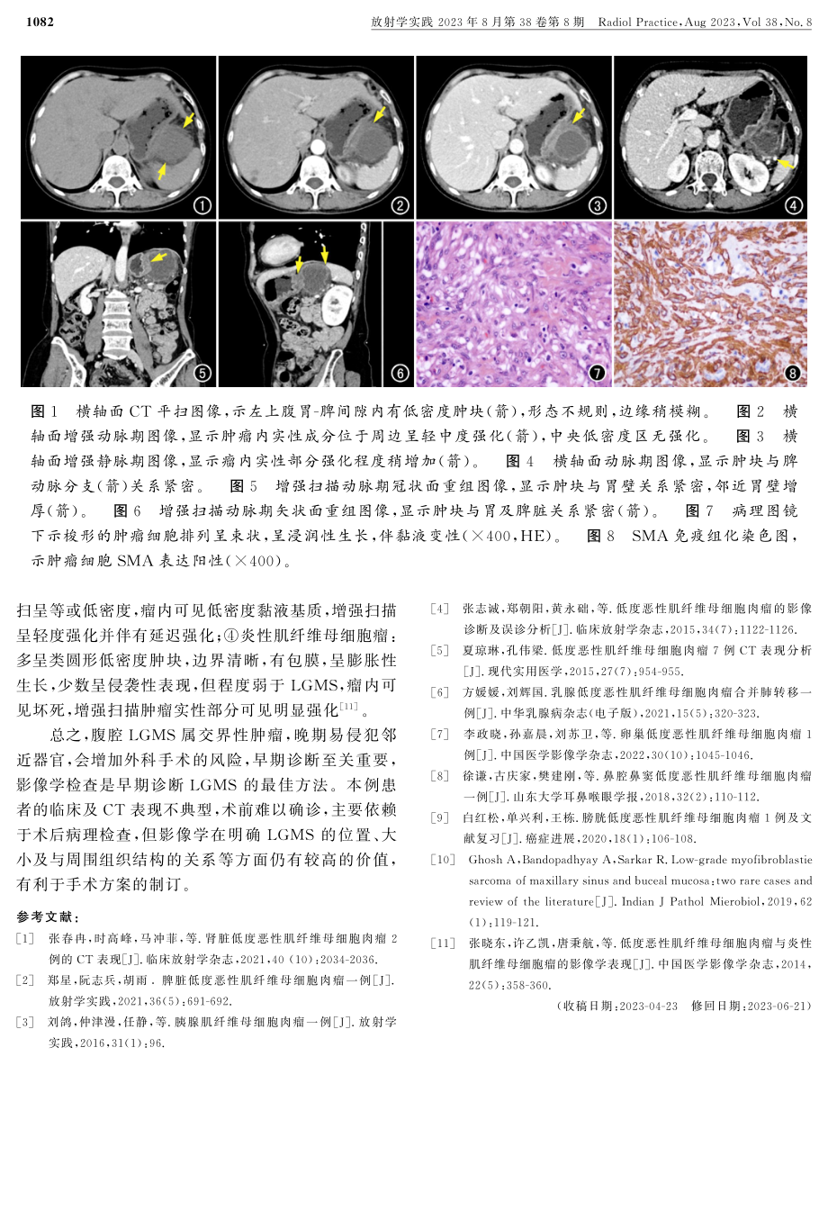 肠系膜低度恶性肌纤维母细胞肉瘤一例.pdf_第2页