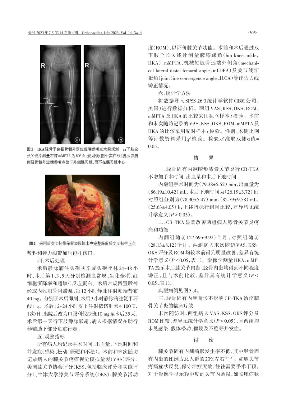 保留后交叉韧带膝关节置换术治疗胫骨固有内翻膝骨关节炎的近期疗效.pdf_第3页