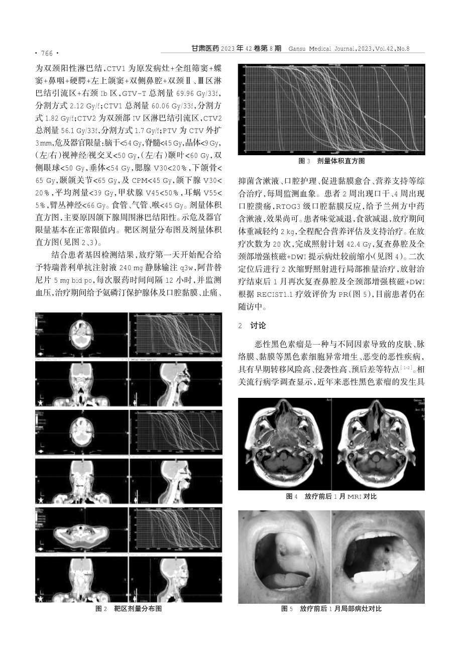 鼻腔黏膜恶性黑色素瘤放疗联合免疫及靶向治疗1例并文献复习.pdf_第2页