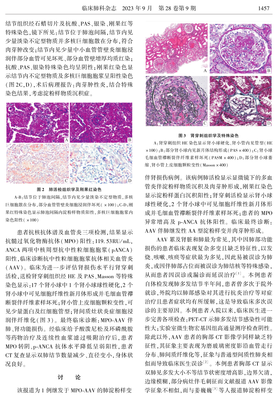 ANCA相关血管炎继发肺淀粉样肉芽肿1例报告.pdf_第2页