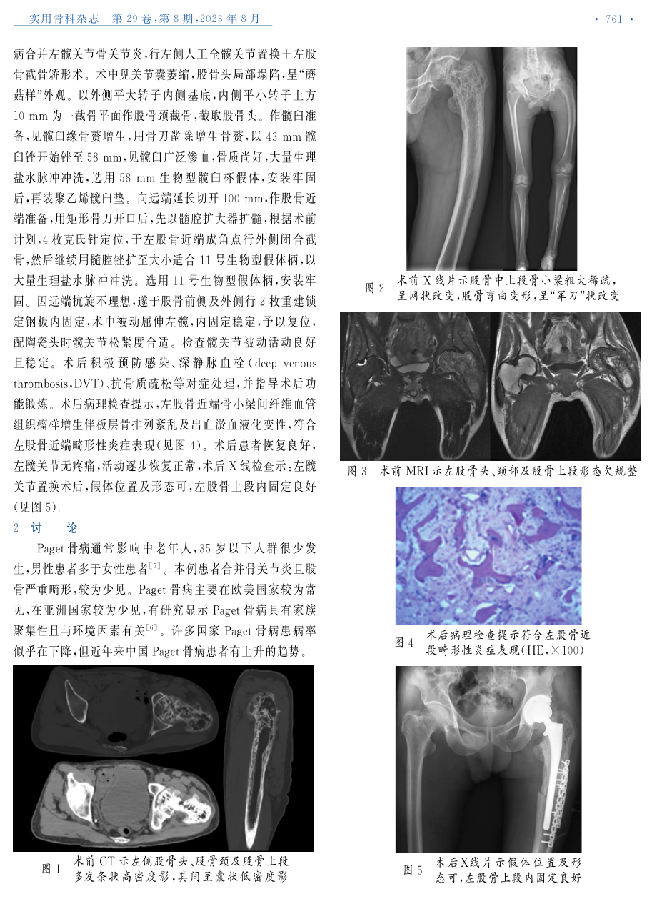 Paget骨病1例报道.pdf_第2页