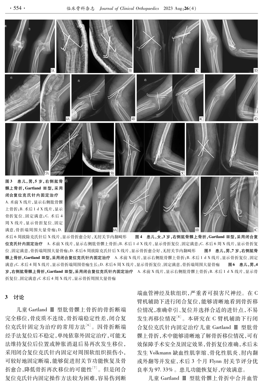 闭合复位克氏针内固定治疗儿童肱骨髁上骨折的疗效.pdf_第3页