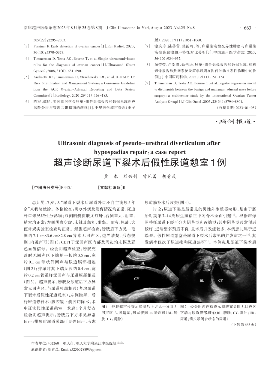 超声诊断尿道下裂术后假性尿道憩室1例.pdf_第1页