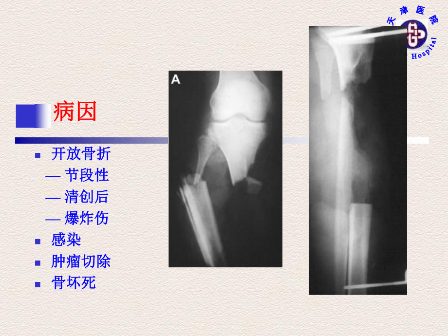 Ilizarov技术修复胫骨骨缺损.pdf_第3页