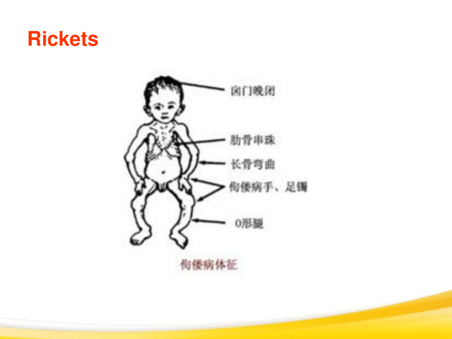 佝偻病与手足搐搦2013.ppt_第3页