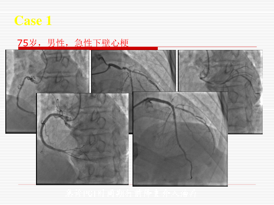 冠心病讲义.ppt_第2页